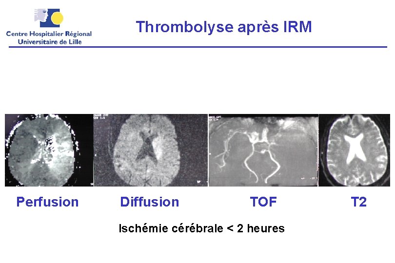 Thrombolyse après IRM Perfusion Diffusion TOF Ischémie cérébrale < 2 heures T 2 