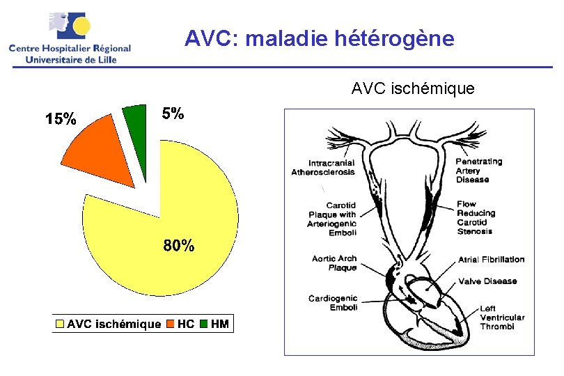 AVC: maladie hétérogène AVC ischémique 