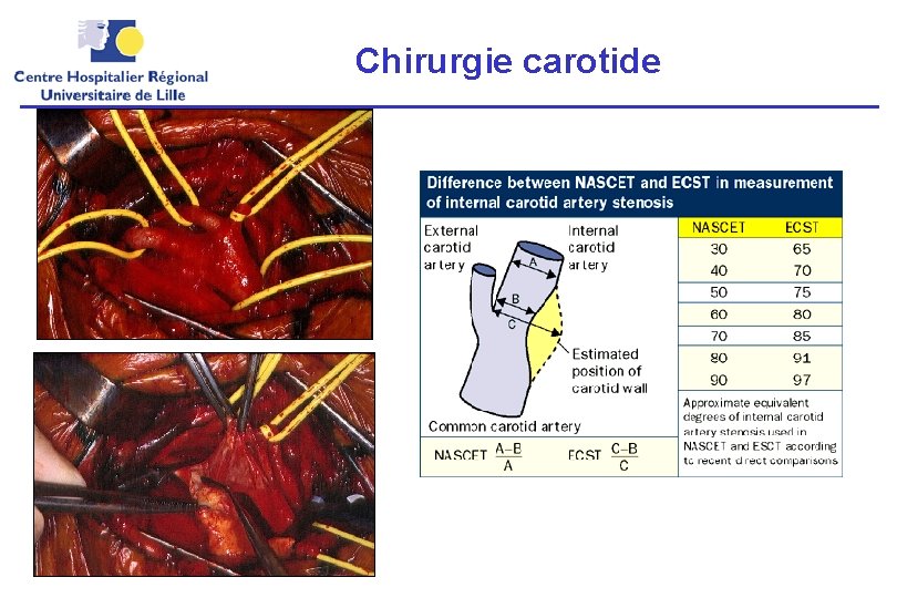 Chirurgie carotide 