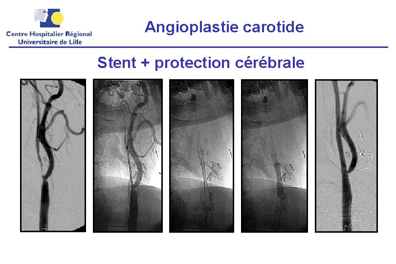 Angioplastie carotide Stent + protection cérébrale 