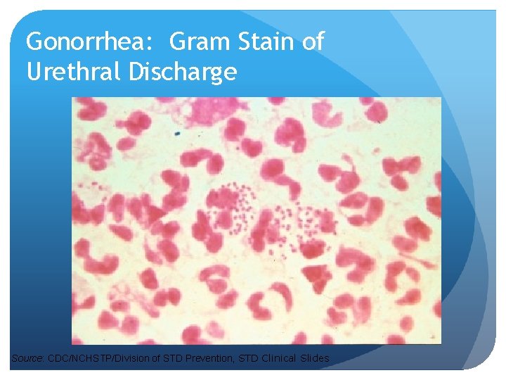 Gonorrhea: Gram Stain of Urethral Discharge Source: CDC/NCHSTP/Division of STD Prevention, STD Clinical Slides