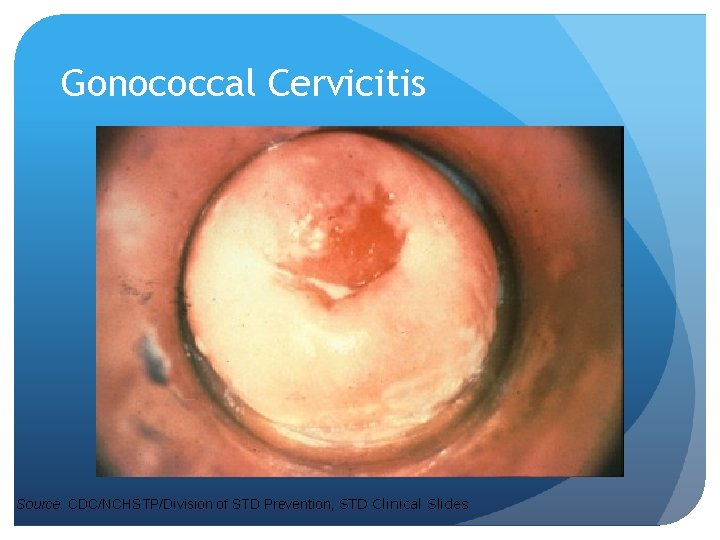 Gonococcal Cervicitis Source: CDC/NCHSTP/Division of STD Prevention, STD Clinical Slides 
