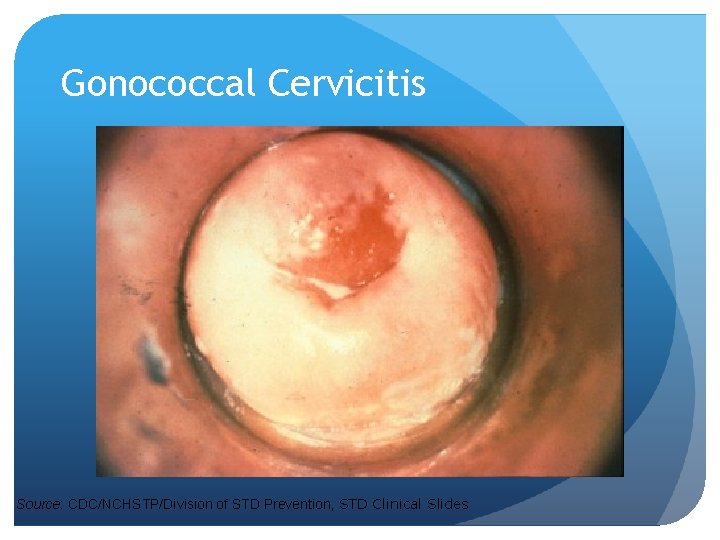 Gonococcal Cervicitis Source: CDC/NCHSTP/Division of STD Prevention, STD Clinical Slides Gonococcal Cervicitis Source: CDC/NCHSTP/Division of STD Prevention, STD Clinical Slides