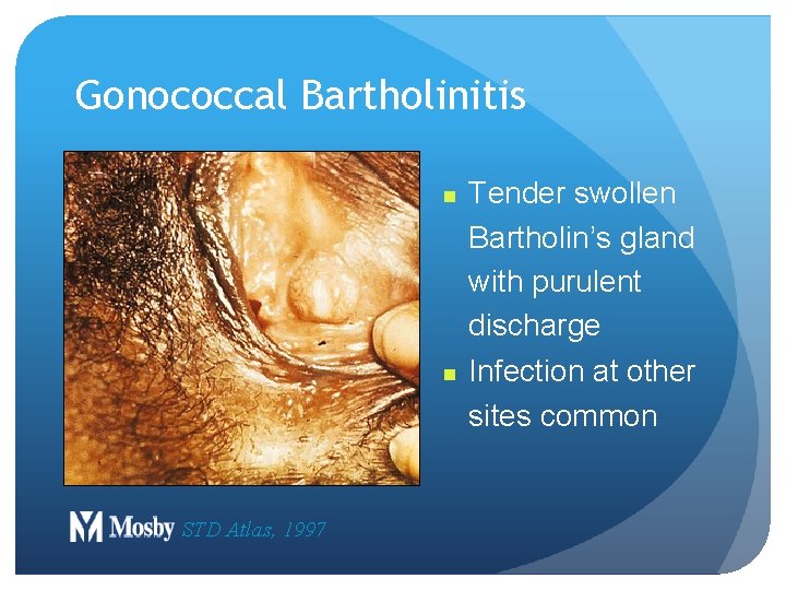 Gonococcal Bartholinitis n n STD Atlas, 1997 Tender swollen Bartholin’s gland with purulent discharge