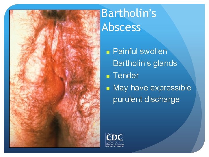 Bartholin’s Abscess n n n Painful swollen Bartholin’s glands Tender May have expressible purulent