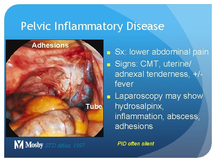 Pelvic Inflammatory Disease Adhesions n n n Tube STD Atlas, 1997 Sx: lower abdominal