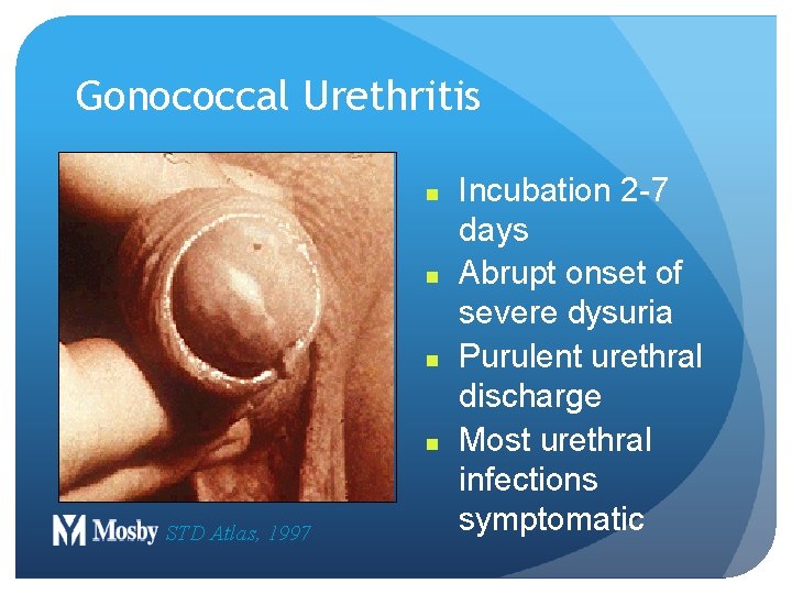 Gonococcal Urethritis n n STD Atlas, 1997 Incubation 2 -7 days Abrupt onset of