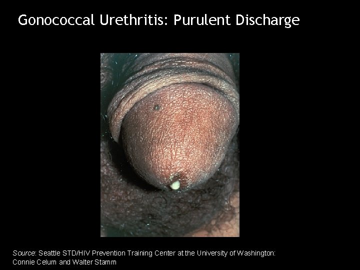 Gonococcal Urethritis: Purulent Discharge Source: Seattle STD/HIV Prevention Training Center at the University of