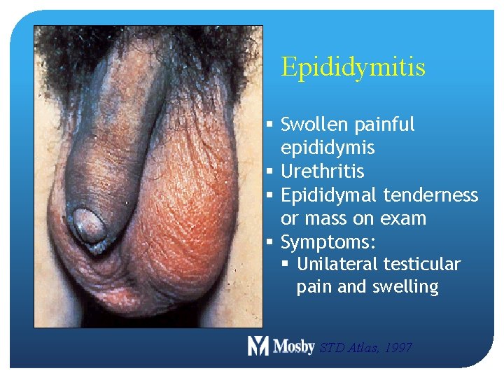 Epididymitis § Swollen painful epididymis § Urethritis § Epididymal tenderness or mass on exam Epididymitis § Swollen painful epididymis § Urethritis § Epididymal tenderness or mass on exam