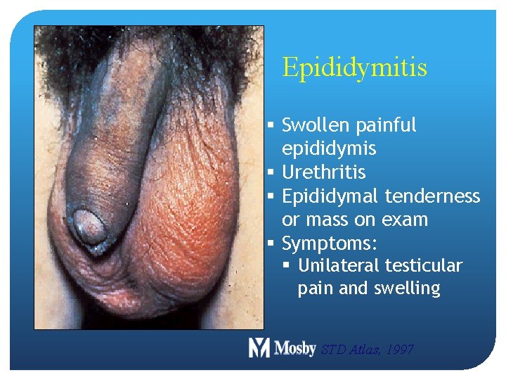 Epididymitis § Swollen painful epididymis § Urethritis § Epididymal tenderness or mass on exam