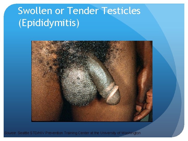 Swollen or Tender Testicles (Epididymitis) Source: Seattle STD/HIV Prevention Training Center at the University