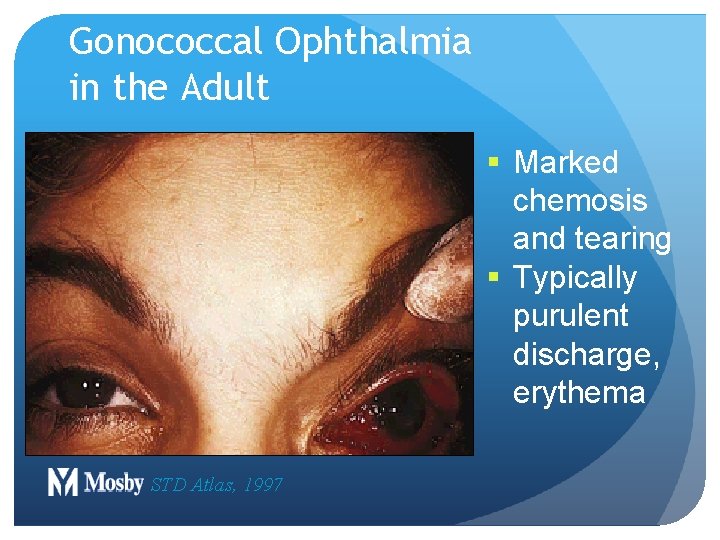 Gonococcal Ophthalmia in the Adult § Marked chemosis and tearing § Typically purulent discharge, Gonococcal Ophthalmia in the Adult § Marked chemosis and tearing § Typically purulent discharge,