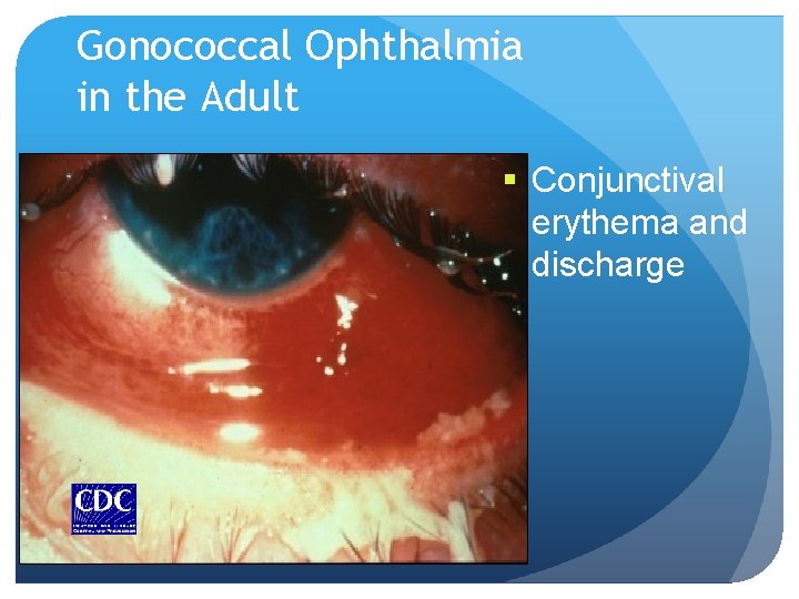 Gonococcal Ophthalmia in the Adult § Conjunctival erythema and discharge Gonococcal Ophthalmia in the Adult § Conjunctival erythema and discharge