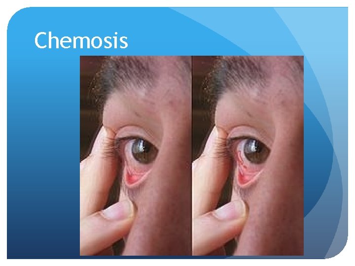 Chemosis 