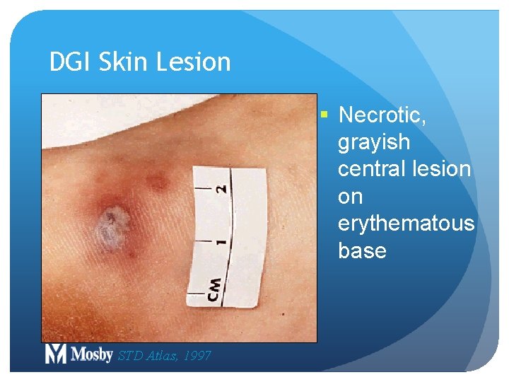 DGI Skin Lesion § Necrotic, grayish central lesion on erythematous base STD Atlas, 1997 DGI Skin Lesion § Necrotic, grayish central lesion on erythematous base STD Atlas, 1997