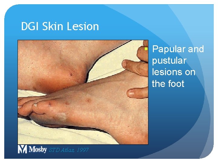 DGI Skin Lesion § Papular and pustular lesions on the foot STD Atlas, 1997 DGI Skin Lesion § Papular and pustular lesions on the foot STD Atlas, 1997