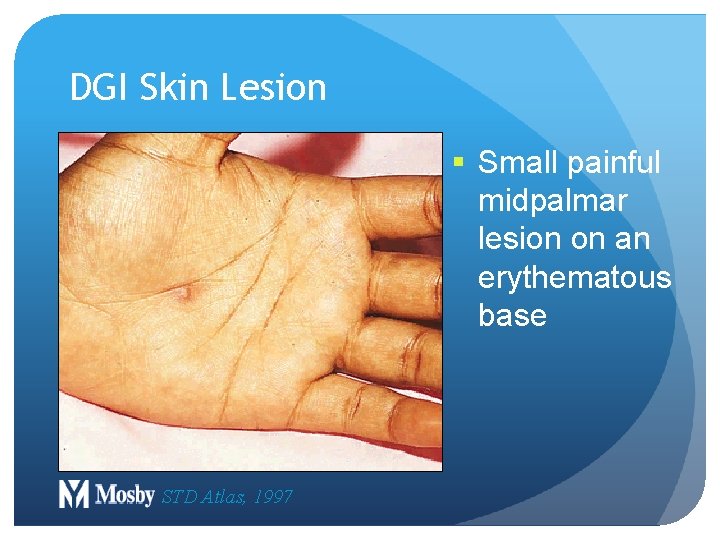 DGI Skin Lesion § Small painful midpalmar lesion on an erythematous base STD Atlas,