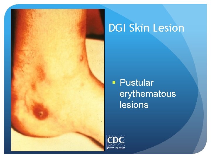 DGI Skin Lesion § Pustular erythematous lesions DGI Skin Lesion § Pustular erythematous lesions