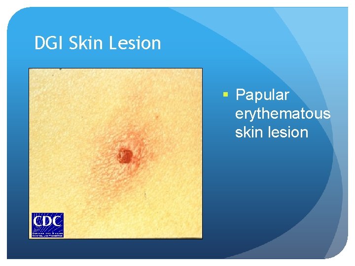 DGI Skin Lesion § Papular erythematous skin lesion 