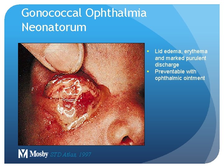 Gonococcal Ophthalmia Neonatorum § § STD Atlas, 1997 Lid edema, erythema and marked purulent