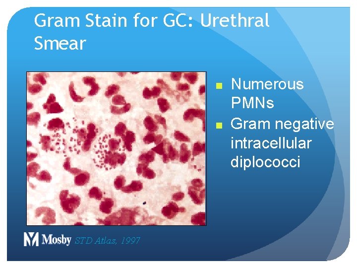 Gram Stain for GC: Urethral Smear n n STD Atlas, 1997 Numerous PMNs Gram Gram Stain for GC: Urethral Smear n n STD Atlas, 1997 Numerous PMNs Gram
