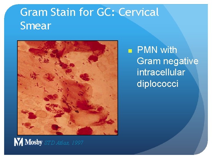 Gram Stain for GC: Cervical Smear n STD Atlas, 1997 PMN with Gram negative