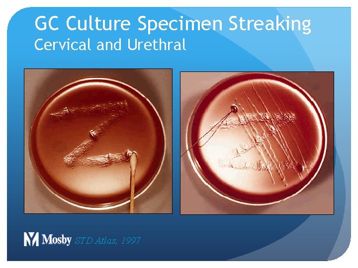GC Culture Specimen Streaking Cervical and Urethral STD Atlas, 1997 GC Culture Specimen Streaking Cervical and Urethral STD Atlas, 1997