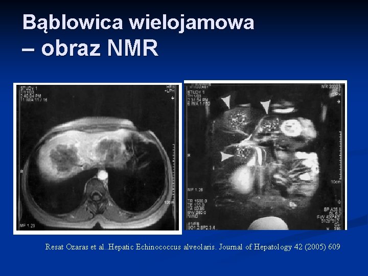 Bąblowica wielojamowa – obraz NMR Resat Ozaras et al. . Hepatic Echinococcus alveolaris. Journal