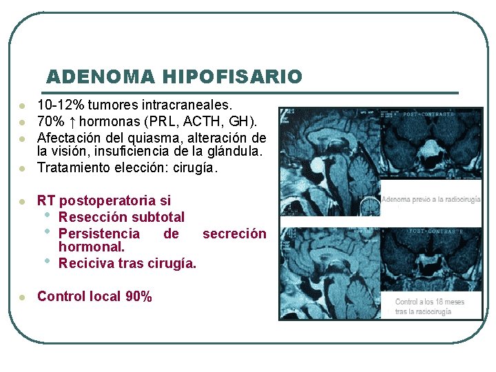 ADENOMA HIPOFISARIO l l 10 -12% tumores intracraneales. 70% ↑ hormonas (PRL, ACTH, GH).