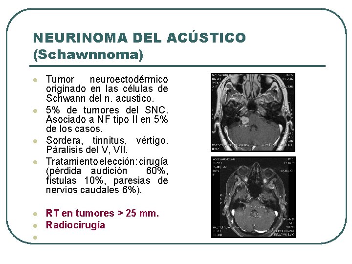 NEURINOMA DEL ACÚSTICO (Schawnnoma) l l l l Tumor neuroectodérmico originado en las células