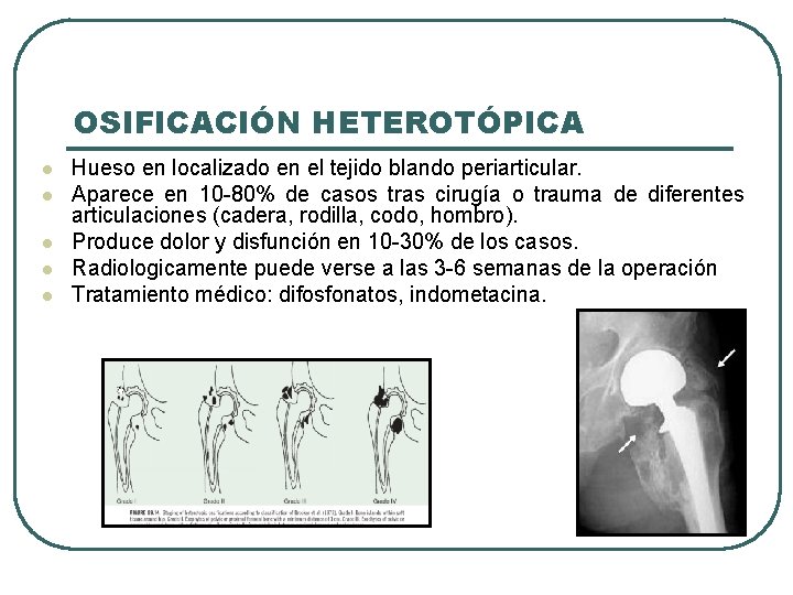 OSIFICACIÓN HETEROTÓPICA l l l Hueso en localizado en el tejido blando periarticular. Aparece