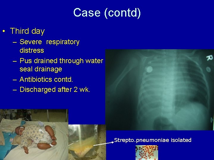 Case (contd) • Third day – Severe respiratory distress – Pus drained through water