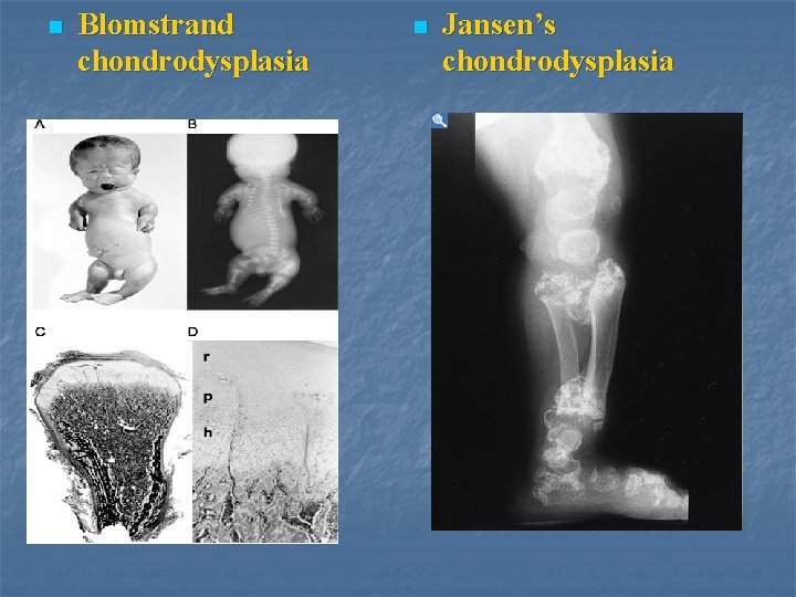 n Blomstrand chondrodysplasia n Jansen’s chondrodysplasia 