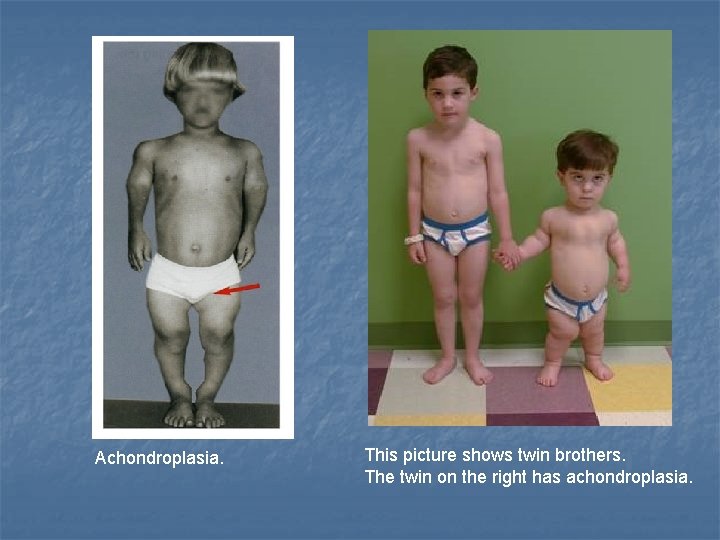 Achondroplasia. This picture shows twin brothers. The twin on the right has achondroplasia. 