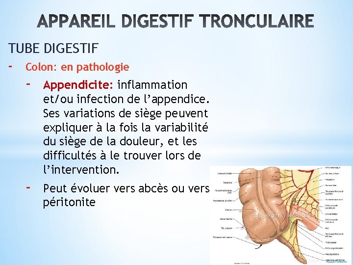 TUBE DIGESTIF - Colon: en pathologie - Appendicite: inflammation et/ou infection de l’appendice. Ses