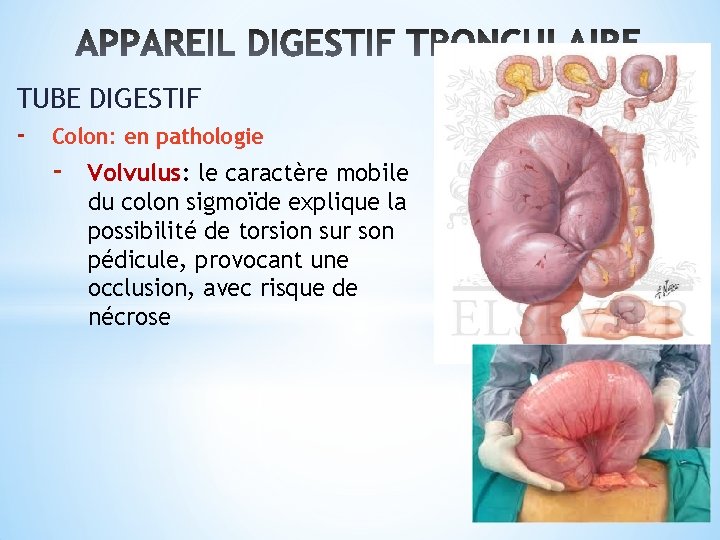 TUBE DIGESTIF - Colon: en pathologie - Volvulus: le caractère mobile du colon sigmoïde