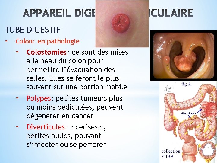 TUBE DIGESTIF - Colon: en pathologie - Colostomies: ce sont des mises à la