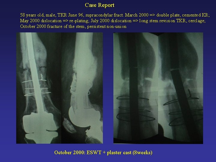 Case Report 58 years old, male, TKR June 96, supracondylar fract. March 2000 =>