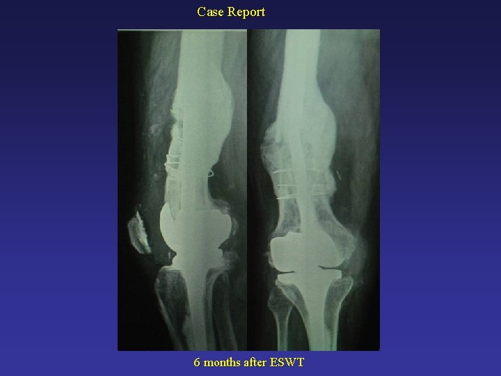 Case Report 6 months after ESWT 