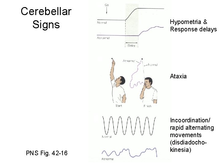 Cerebellar Signs Hypometria & Response delays Ataxia PNS Fig. 42 -16 Incoordination/ rapid alternating