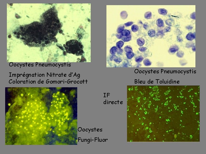Oocystes Pneumocystis Imprégnation Nitrate d’Ag Coloration de Gomori-Grocott Bleu de Toluidine IF directe Oocystes