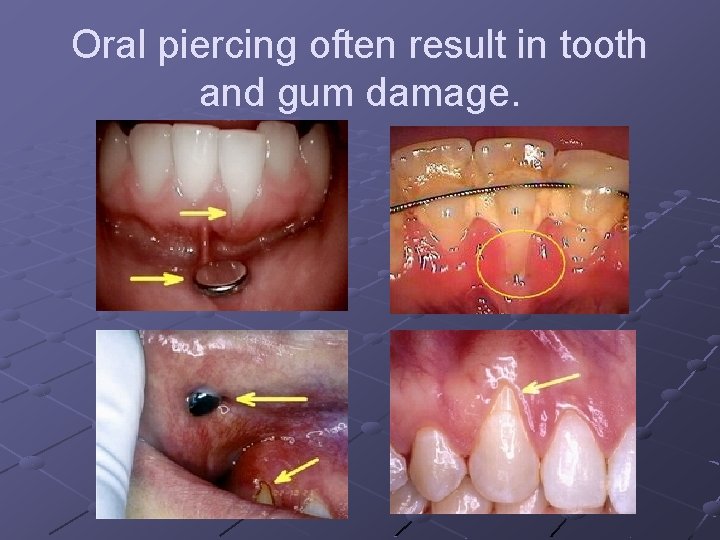 Oral piercing often result in tooth and gum damage. Oral piercing often result in tooth and gum damage.