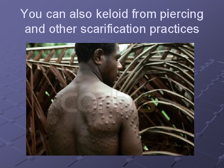 You can also keloid from piercing and other scarification practices You can also keloid from piercing and other scarification practices