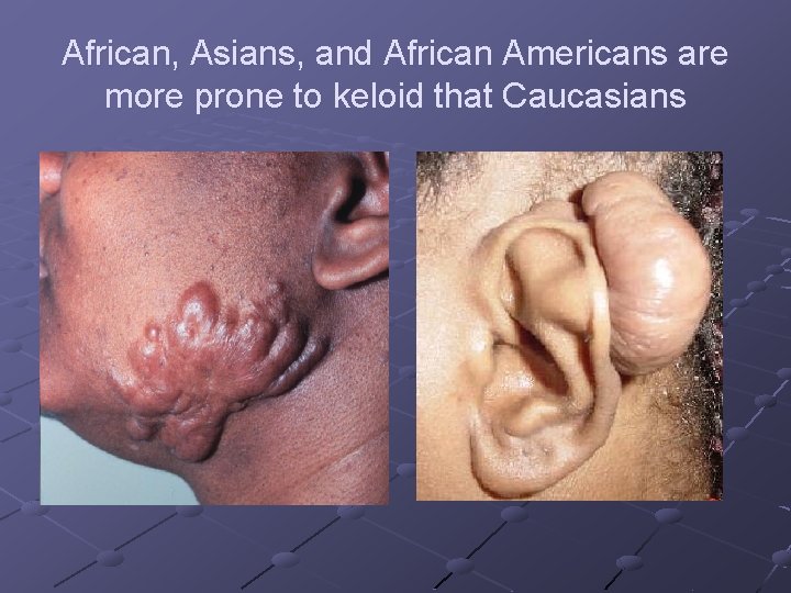 African, Asians, and African Americans are more prone to keloid that Caucasians African, Asians, and African Americans are more prone to keloid that Caucasians