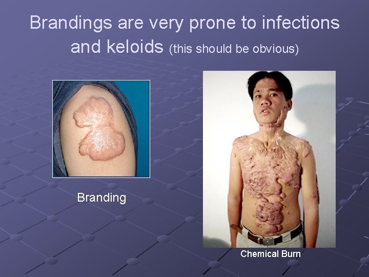 Brandings are very prone to infections and keloids (this should be obvious) Branding Chemical