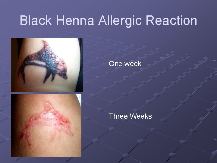 Black Henna Allergic Reaction One week Three Weeks Black Henna Allergic Reaction One week Three Weeks
