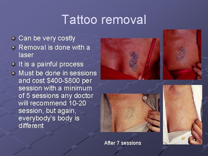 Tattoo removal Can be very costly Removal is done with a laser It is