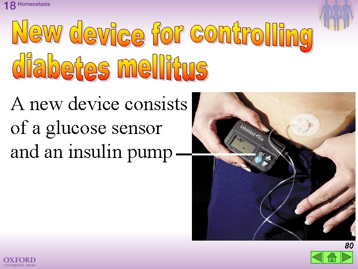 A new device consists of a glucose sensor and an insulin pump 80 