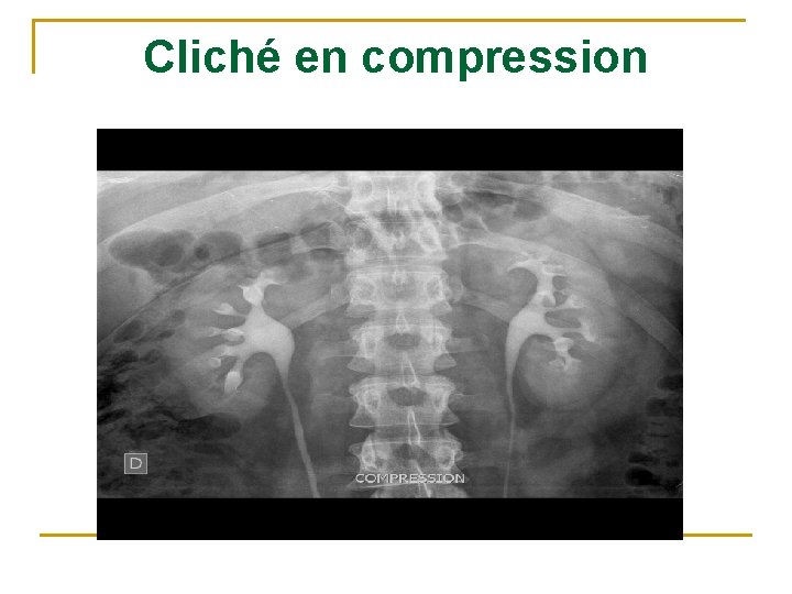 Cliché en compression 