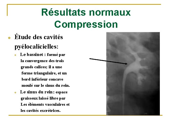 Résultats normaux Compression v Étude des cavités pyélocalicielles: v Le bassinet : formé par